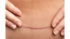Scar from an abdominal myomectomy.